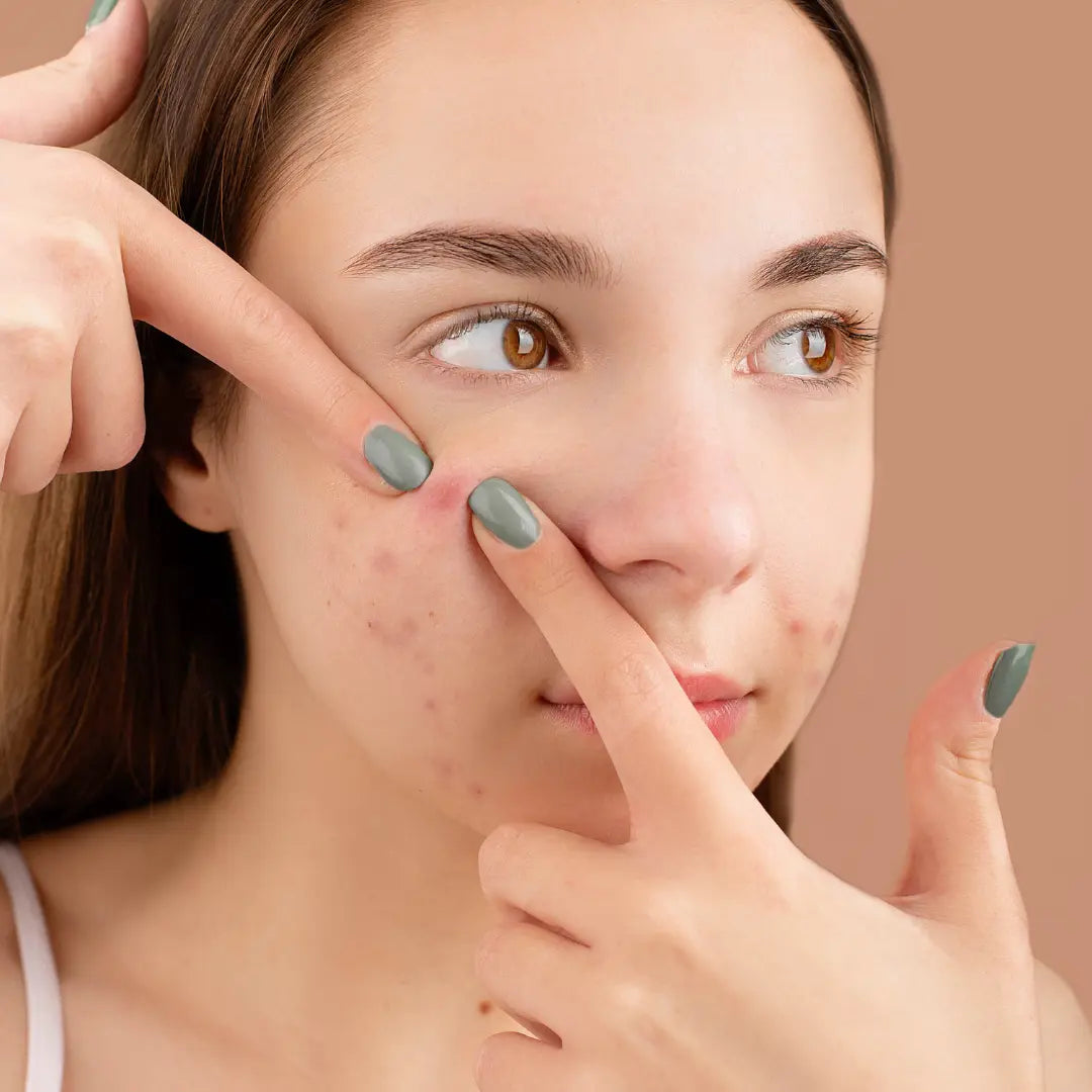 How to Use Blemish Control Gel to Combat Adult Acne Effectively