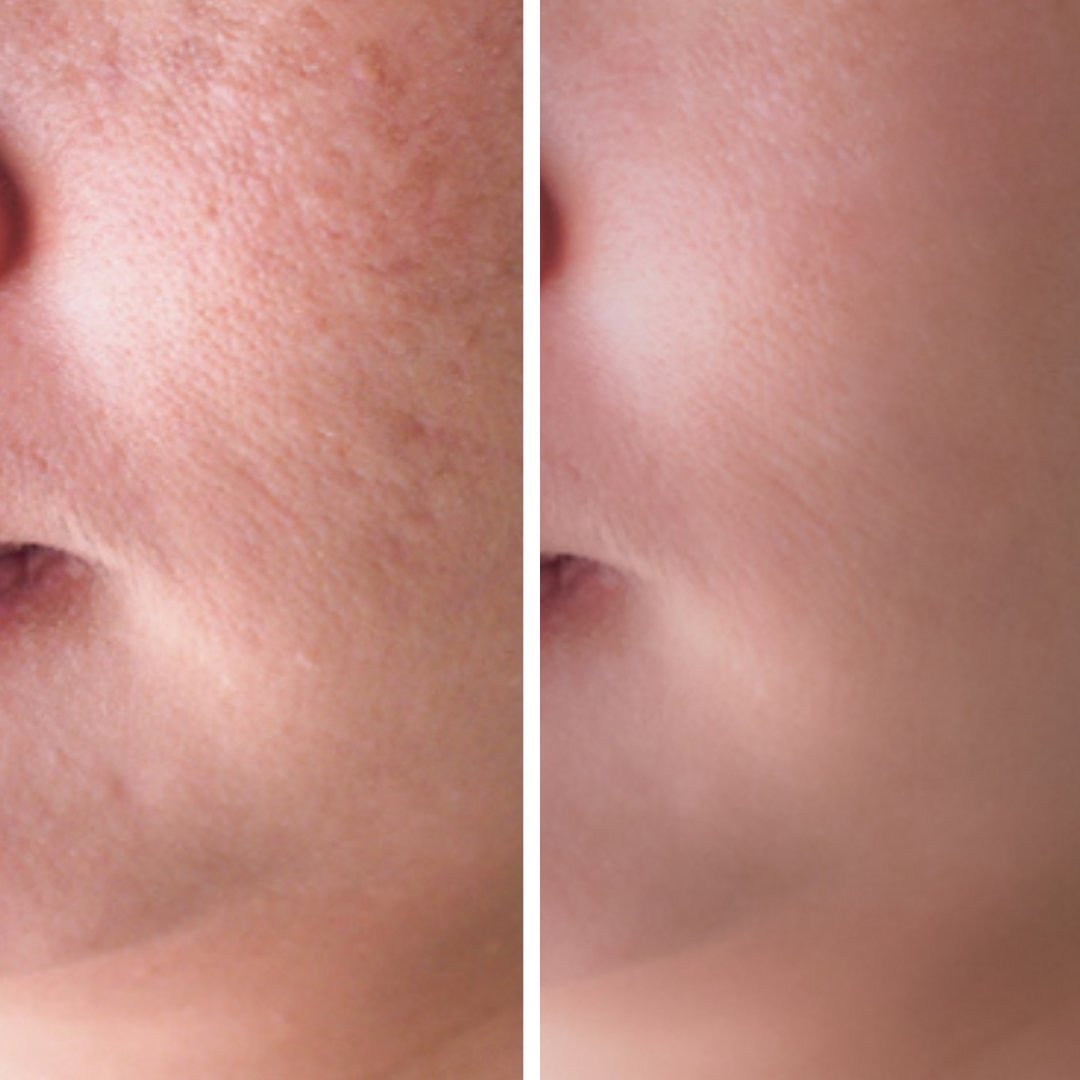 Safe Skincare Tips for Lightening and Brightening Skin without Hydroquinone - Miracles & More
