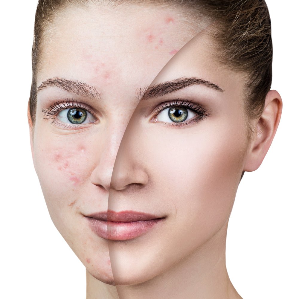 The 5 Must-Have Ingredients for Acne-Prone Skin - Miracles & More
